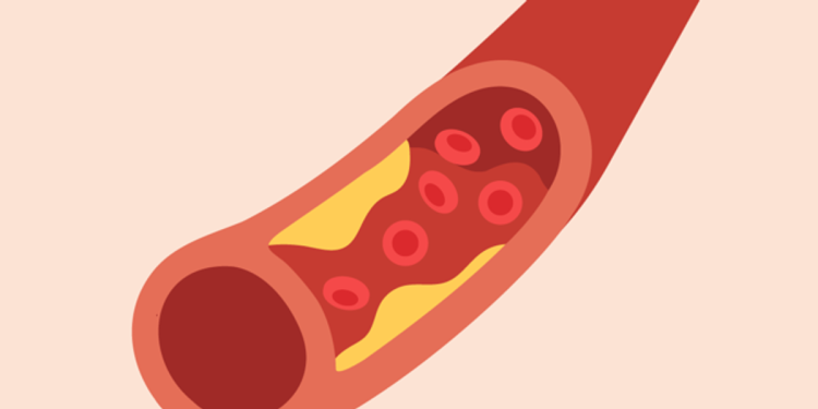 Aterosclerosis y enfermedades cardíacas – HealthyWomen