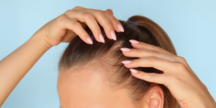 Lo que la puntuación SALT puede (y no puede) decirle sobre la alopecia areata