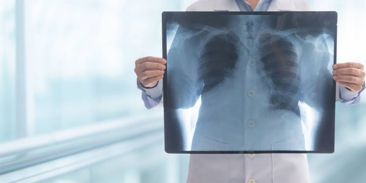 Datos sobre la detección del cáncer de pulmón