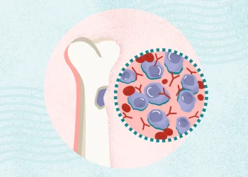 ¿Qué es el mieloma múltiple? Síntomas, Causas, Diagnóstico, Tratamiento y Prevención