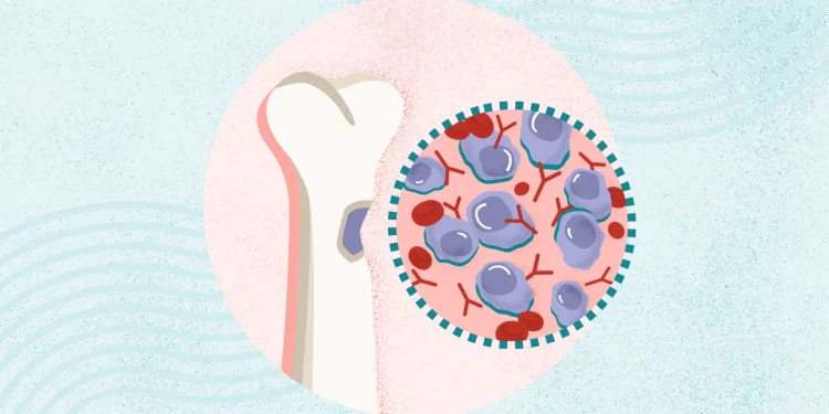 ¿Qué es el mieloma múltiple? Síntomas, Causas, Diagnóstico, Tratamiento y Prevención