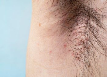 Todo lo que necesita saber sobre los piojos del cuerpo, incluidos los síntomas y tratamientos