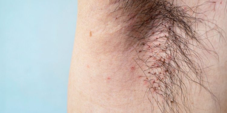 Todo lo que necesita saber sobre los piojos del cuerpo, incluidos los síntomas y tratamientos