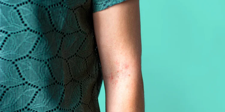 Cómo afecta la enfermedad de Crohn a su piel