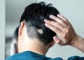 Avances nuevos y futuros en el tratamiento de la alopecia areata