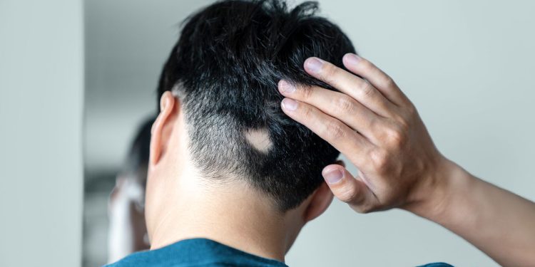 Avances nuevos y futuros en el tratamiento de la alopecia areata