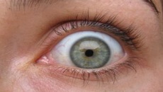 Gusano de diez centímetros nace en la frente de una mujer y se arrastra hasta su párpado
