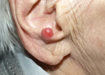 ¿Qué es el carcinoma de células de Merkel?