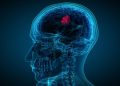 Seis síntomas poco conocidos que podrían alertar sobre un tumor cerebral