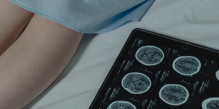 Nuevas claves explican cómo afecta un ictus a la comprensión del habla.