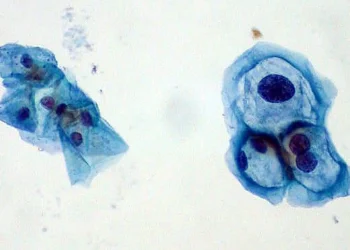 Aumenta el riesgo de contraer el virus del papiloma humano en varones de más de 45 años