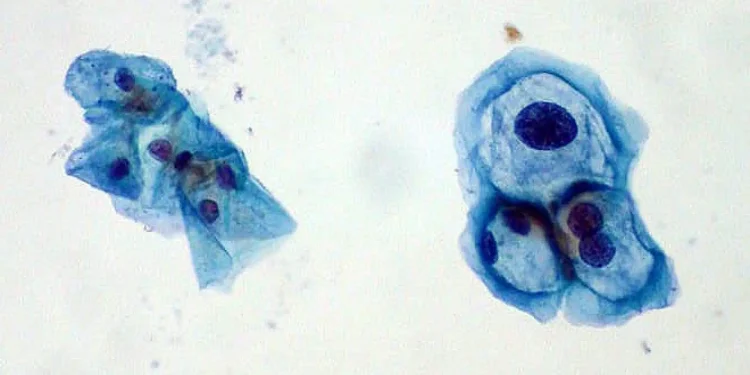 Aumenta el riesgo de contraer el virus del papiloma humano en varones de más de 45 años