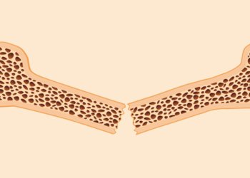 Tratamientos para la osteoporosis – Mujeres Saludables